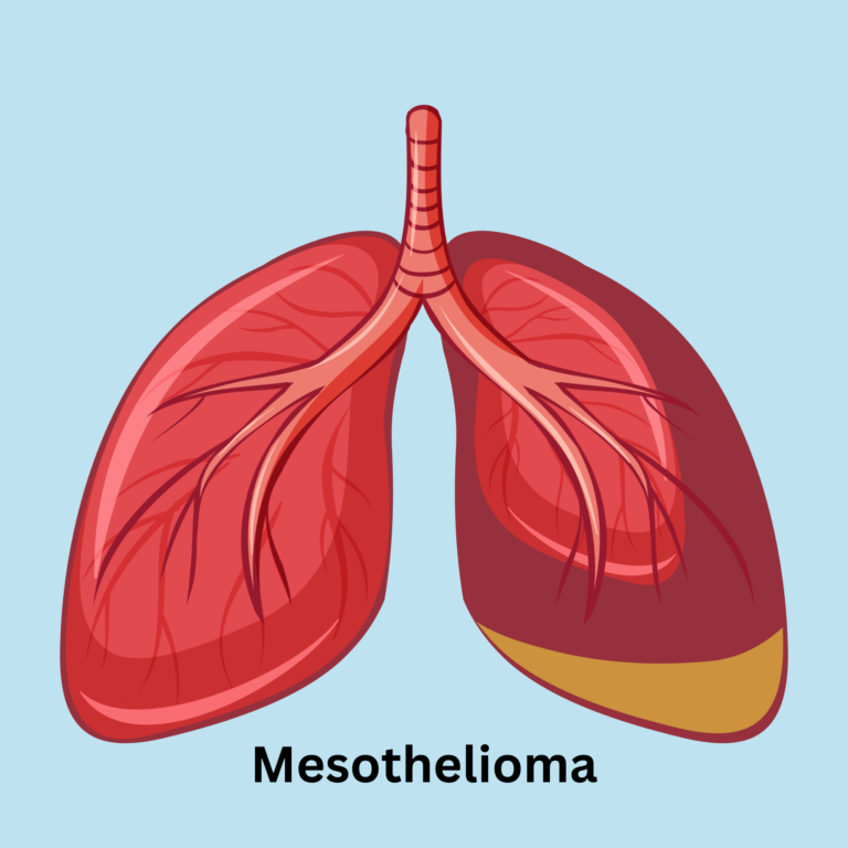 What Is Mesothelioma Understanding Mesothelioma