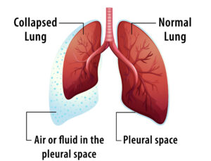 Plura Mesothelioma